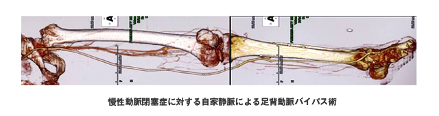 慢性動脈閉塞症に対する自家静脈による足背動脈バイパス術の図