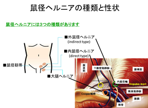 鼠径ヘルニアの種類と性状の図