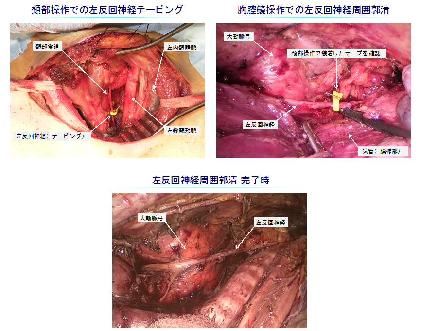 食道癌手術の図