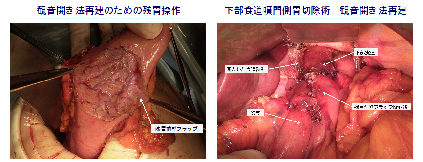 食道胃接合部癌手術の図