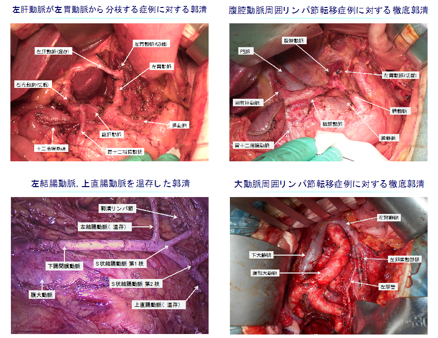 胃癌, 大腸癌手術の図