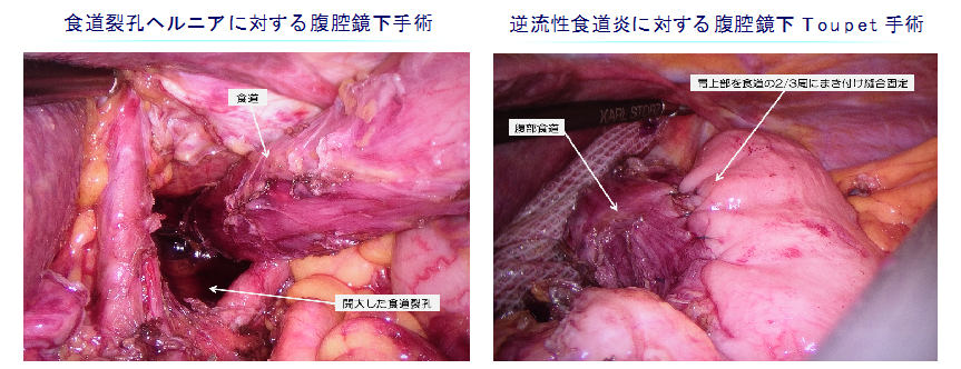 食道の手術の図