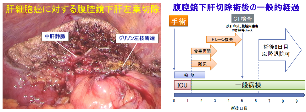肝細胞癌に対する腹腔鏡下肝左葉切除の予後の図