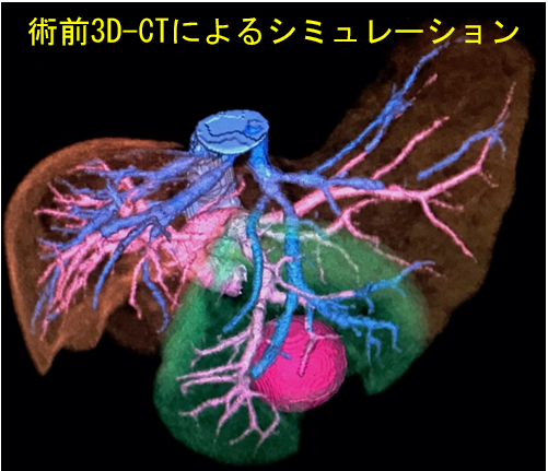 術前3D-CTによるシミレーションの図