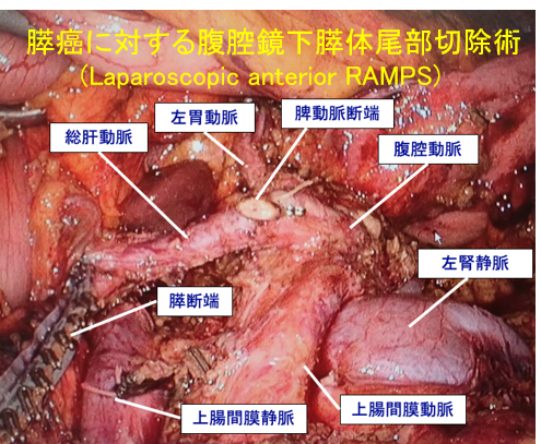 膵癌に対する腹腔鏡下膵体尾部切除術の図