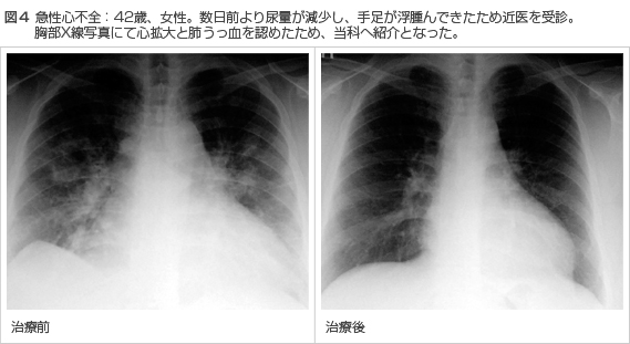 急性心不全症例の図
